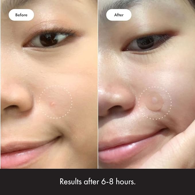 Mighty Patch Hero Cosmetics Original Patch – Hydrocolloid Acne Pimple Patch for Covering Zits and Blemishes, Spot Stickers for Face and Skin (36 Count) - Image 3